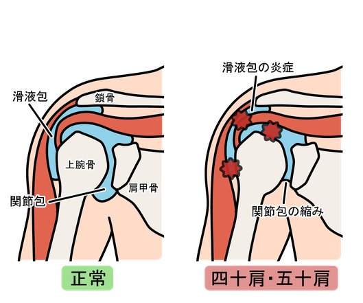 五十肩のイメージ画像